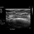 Normal breast mammography (tomosynthesis) and ultrasound (Radiopaedia 65325-74354 Right breast 8).jpeg