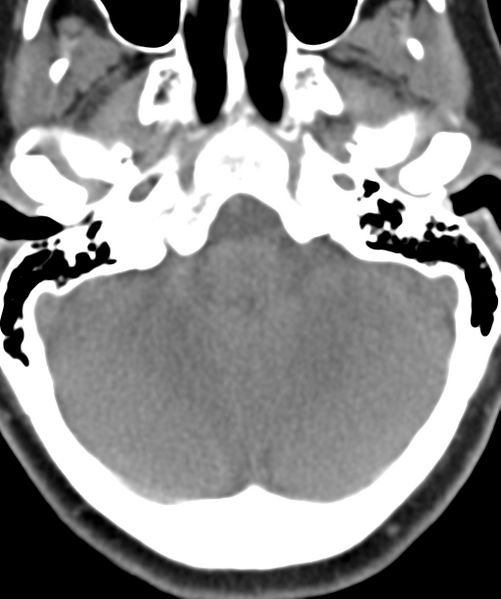 File:Normal cervical spine MRI (including Dixon) (Radiopaedia 42762-45926 Axial non-contrast 2).png