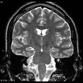 Normal coronal brain (Radiopaedia 6676-7910 Coronal T2 23).jpg