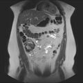 Normal liver MRI with Gadolinium (Radiopaedia 58913-66163 Coronal T2 13).jpg
