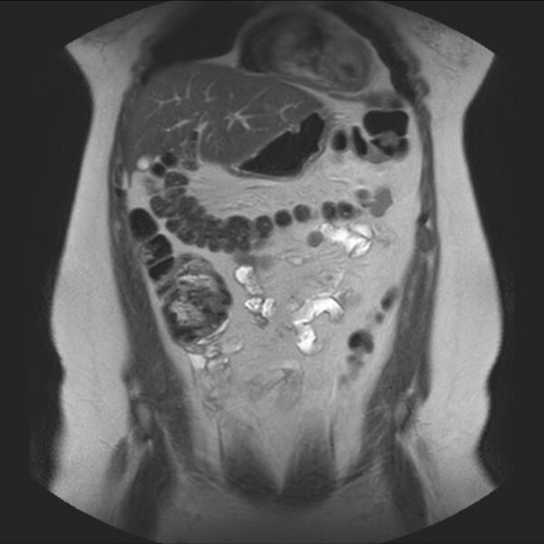 File:Normal liver MRI with Gadolinium (Radiopaedia 58913-66163 Coronal T2 13).jpg