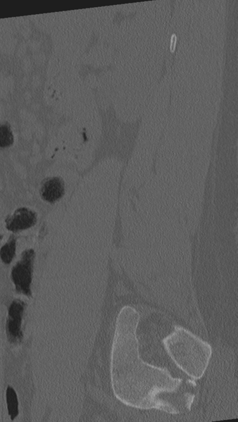 File:Normal lumbar spine CT (Radiopaedia 46533-50986 Sagittal bone window 18).png