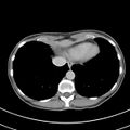 Normal multiphase CT liver (Radiopaedia 38026-39996 Axial C+ delayed 3).jpg