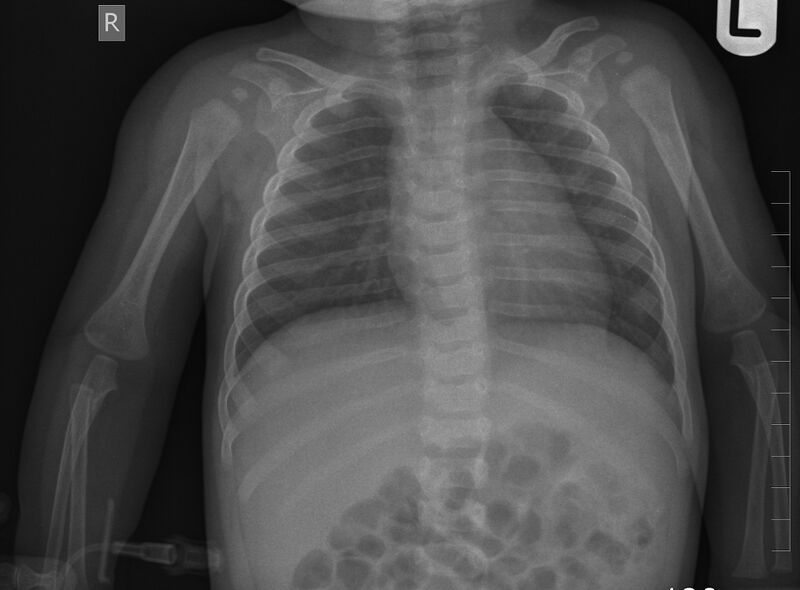 File:Normal skeletal survey - 5-month-old (Radiopaedia 53220-59186 Frontal 1).jpg