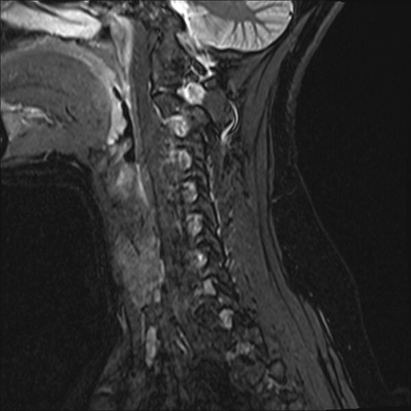 File:Normal trauma cervical spine MRI (Radiopaedia 32130-33071 Sagittal STIR 3).jpg