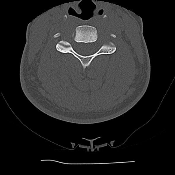 File:Normal trauma spine imaging (Radiopaedia 31753-32686 Axial bone window 41).jpg