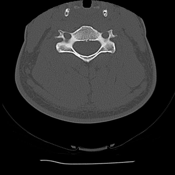 File:Normal trauma spine imaging (Radiopaedia 31753-32686 Axial bone window 48).jpg