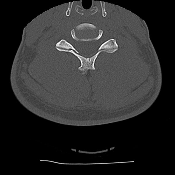 File:Normal trauma spine imaging (Radiopaedia 31753-32686 Axial bone window 52).jpg