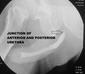 Normal urethra (Radiopaedia 30340-30986 oblique 1).jpg