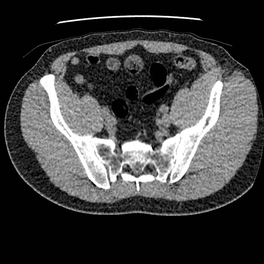 Obstructing ureteric calculus and ureteric anatomy (Radiopaedia 62730-71042 Axial non-contrast 126).jpg