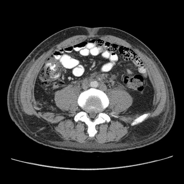 File:Obstructive bladder transitional cell carcinoma (Radiopaedia 9825-10410 A 17).jpg