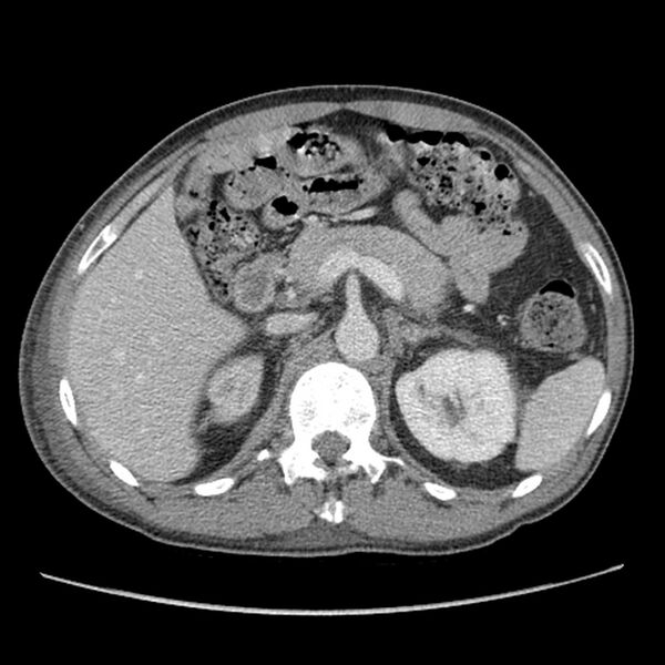 File:Obstructive bladder transitional cell carcinoma (Radiopaedia 9825-10410 A 6).jpg