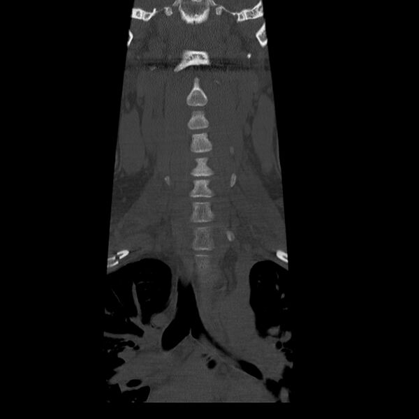 File:Occipital condyle fracture (Radiopaedia 31755-32691 Coronal bone window 7).jpg