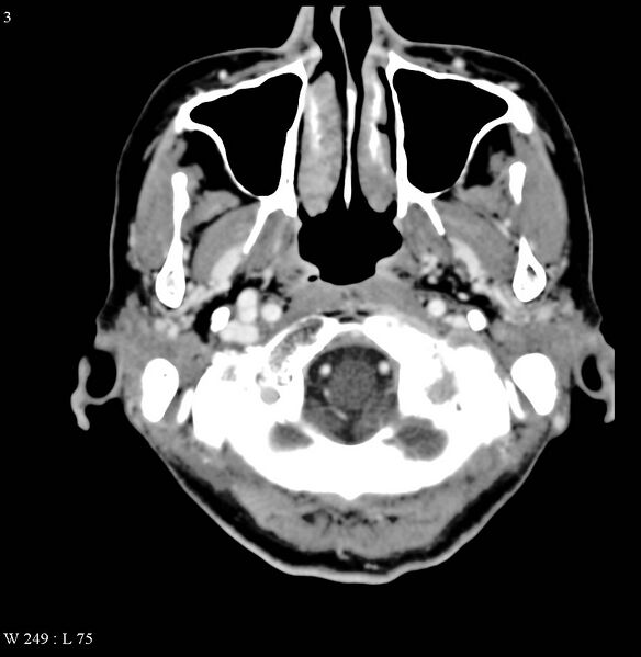 File:Occipital condyle metastasis - into mastoid (Radiopaedia 5424-7177 B 3).jpg