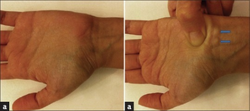 Piezogenic papules (wrist)