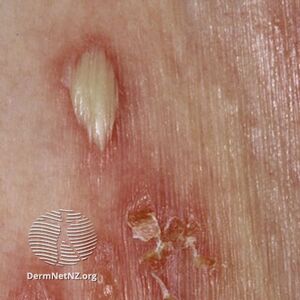 Subcorneal pustular dermatosis (DermNet NZ scaly-s-sneddwilk1).jpg