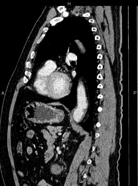 File:Abdominal aortic aneurysm (Radiopaedia 83094-97462 Sagittal renal cortical phase 77).jpg