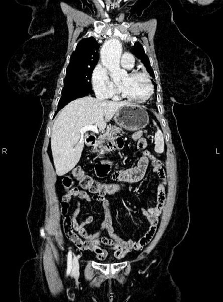 File:Abdominal aortic aneurysm (Radiopaedia 85063-100606 Coronal C+ arterial phase 15).jpg
