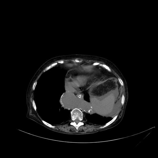 File:Abdominal aortic aneurysm - impending rupture (Radiopaedia 19233-19246 Axial non-contrast 19).jpg