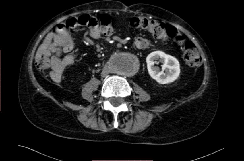 Abdominal aortic interposition tube graft and aneurysm thrombosis (Radiopaedia 71438-81857 Axial C+ arterial phase 101).jpg