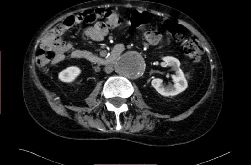 File:Abdominal aortic interposition tube graft and aneurysm thrombosis (Radiopaedia 71438-81857 Axial C+ arterial phase 75).jpg