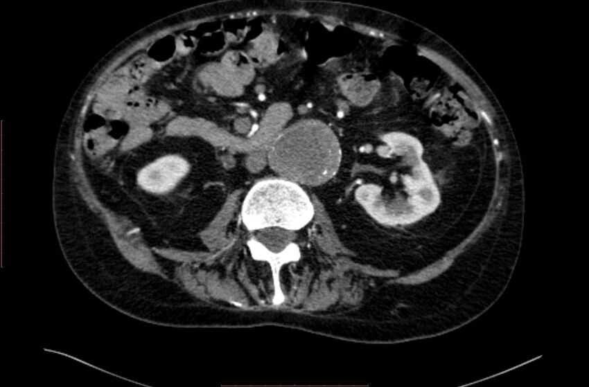 Abdominal aortic interposition tube graft and aneurysm thrombosis (Radiopaedia 71438-81857 Axial C+ arterial phase 75).jpg