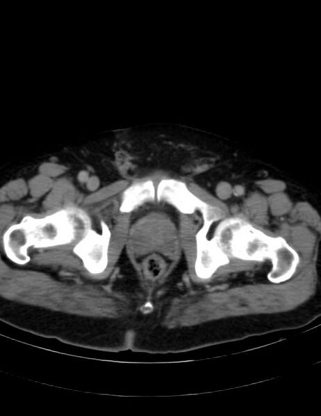 File:Abdominal lymphoma - with sandwich sign (Radiopaedia 53486-59492 Axial C+ portal venous phase 50).jpg
