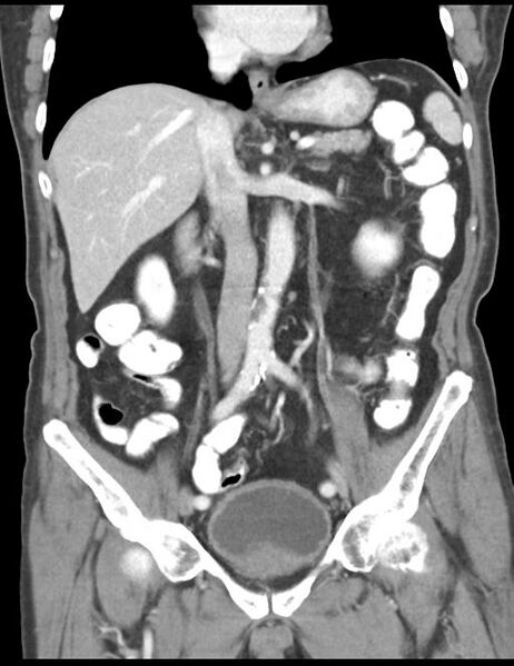 File:Abdominal wall metastasis from colorectal carcinoma (Radiopaedia 31016-31717 Coronal C+ portal venous phase 24).jpg