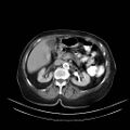 Abdominal wall recurrence after colorectal resection for cancer (Radiopaedia 23444-23523 Axial C+ portal venous phase 9).jpg