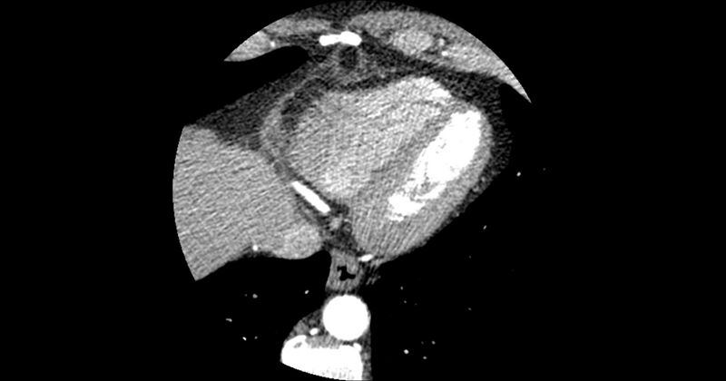 File:Aberrant left main coronary artery (ALMCA) arising from the right sinus with interarterial course (Radiopaedia 63251-71814 Axial C+ arterial phase 168).JPG