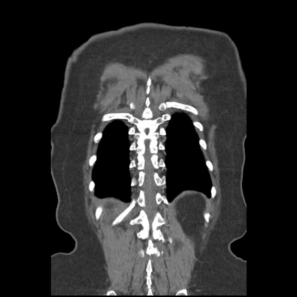 File:Aberrant right subclavian and left vertebral arteries (Radiopaedia 43467-46847 Coronal C+ portal venous phase 77).jpg
