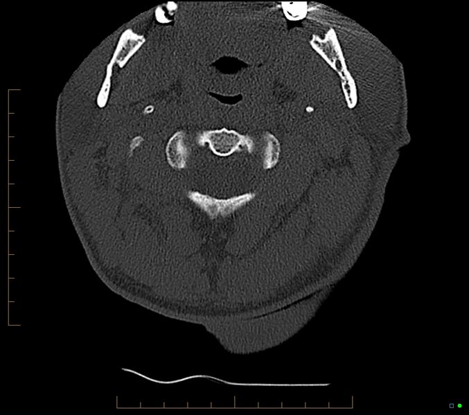 File:Accessory articulation of cervical transverse processes (Radiopaedia 82715-96933 Axial non-contrast 24).jpg