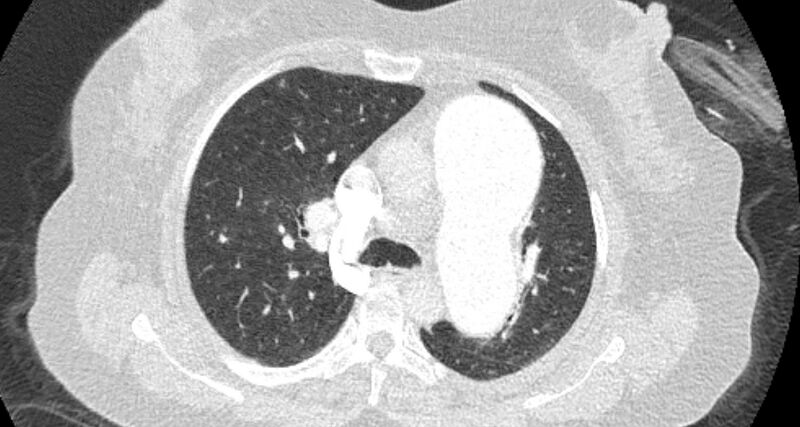 File:Accessory right inferior hepatic vein (Radiopaedia 65245-74259 Axial lung window 22).jpg