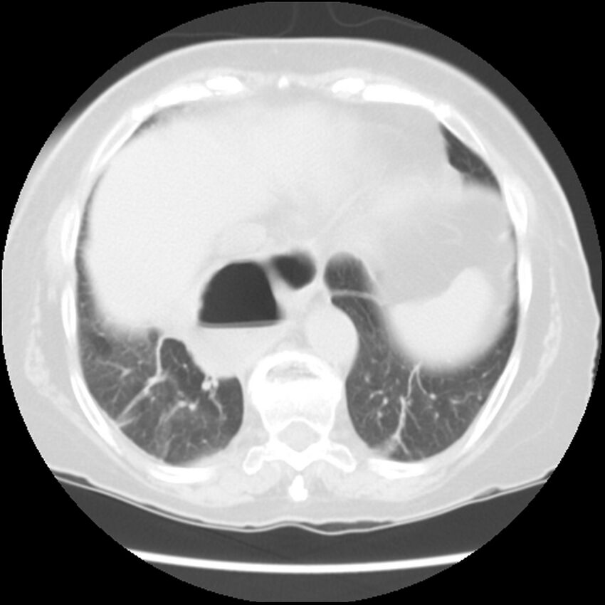 Achalasia (Radiopaedia 44094-47649 Axial lung window 46).jpg