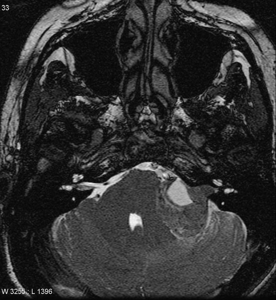 File:Acoustic schwannoma (large with cystic change) (Radiopaedia 5369-7130 Axial T2 4).jpg