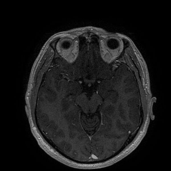 File:Acoustic schwannoma - intracanalicular (Radiopaedia 37247-39024 Axial T1 C+ 107).jpg