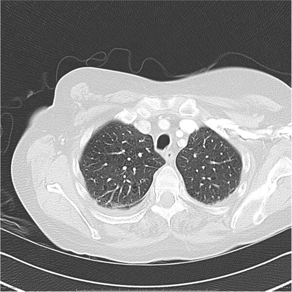 File:Acute-on-chronic pulmonary emboli (Radiopaedia 27925-28169 lung window 9).jpg