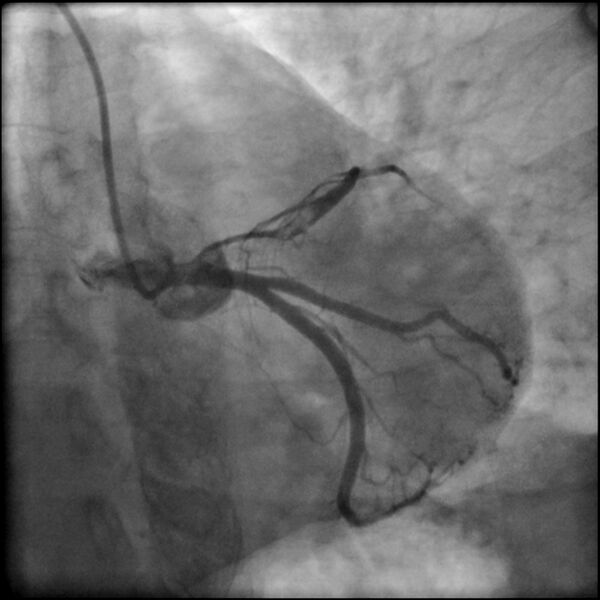 File:Acute anteroseptal myocardial infarction (Radiopaedia 68409-77946 LAO caudal (spider view) LAD and CX 31).jpg
