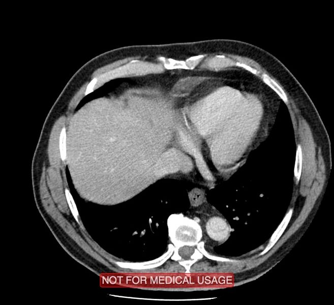 File:Acute aortic dissection - Stanford type A (Radiopaedia 40661-43285 Axial C+ portal venous phase 47).jpg