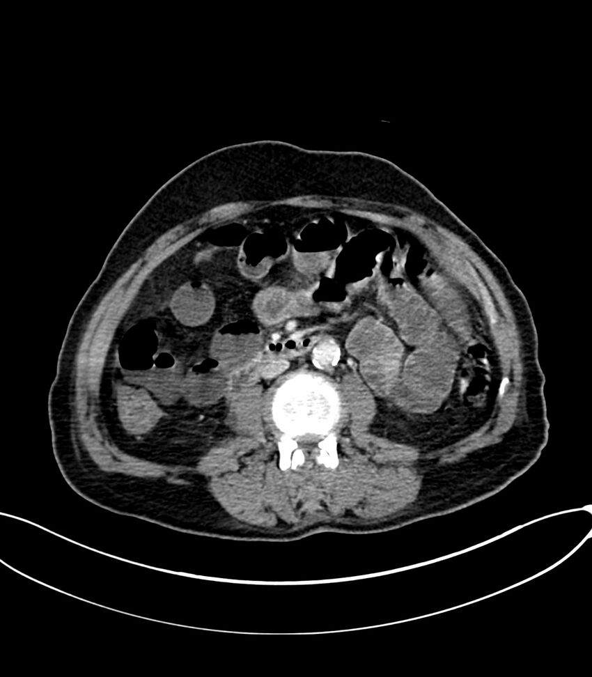 Acute arterial mesenteric ischemia (Radiopaedia 78238-90828 Axial C+ portal venous phase 68).jpg