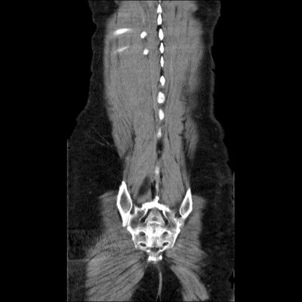 File:Acute cholecystitis and incidental left sided IVC (Radiopaedia 49352-54459 Coronal C+ portal venous phase 10).jpg