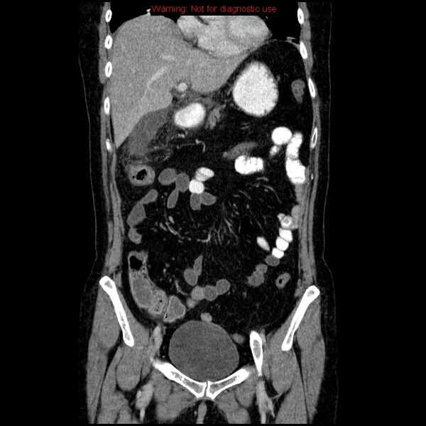 File:Acute gangrenous cholecystitis (Radiopaedia 10123-10661 Coronal C+ portal venous phase 6).jpg
