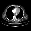 Acute heart failure (CT) (Radiopaedia 79835-93075 Axial C+ arterial phase 35).jpg