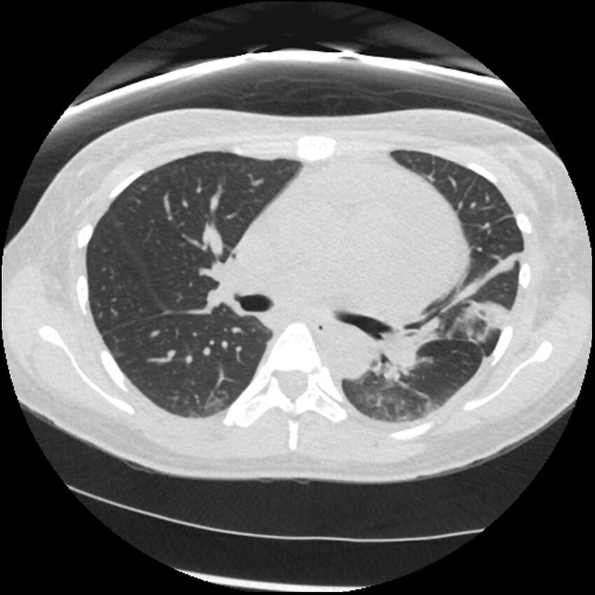 Acute lupus nephritis (Radiopaedia 45832-50107 Axial lung window 38).jpg