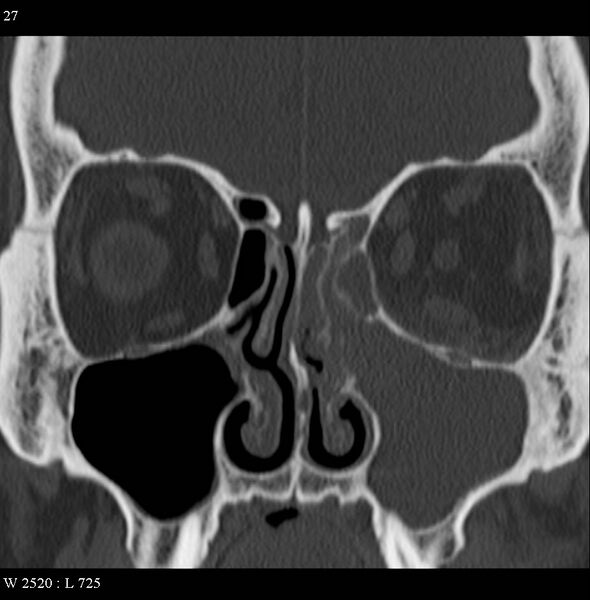 File:Acute maxillary sinusitis (Radiopaedia 4890-6825 Coronal bone window 1).jpg