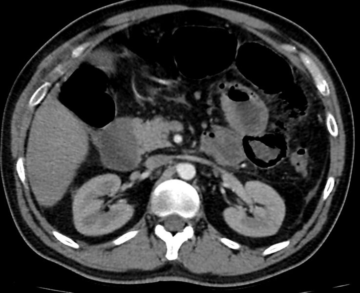 File:Acute mesenteric ischemia - superior mesenteric artery thrombosis (Radiopaedia 73947-84776 Axial C+ arterial phase 31).jpg