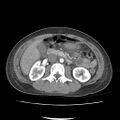 Acute myocarditis (Radiopaedia 55988-62613 Axial C+ portal venous phase 33).jpg