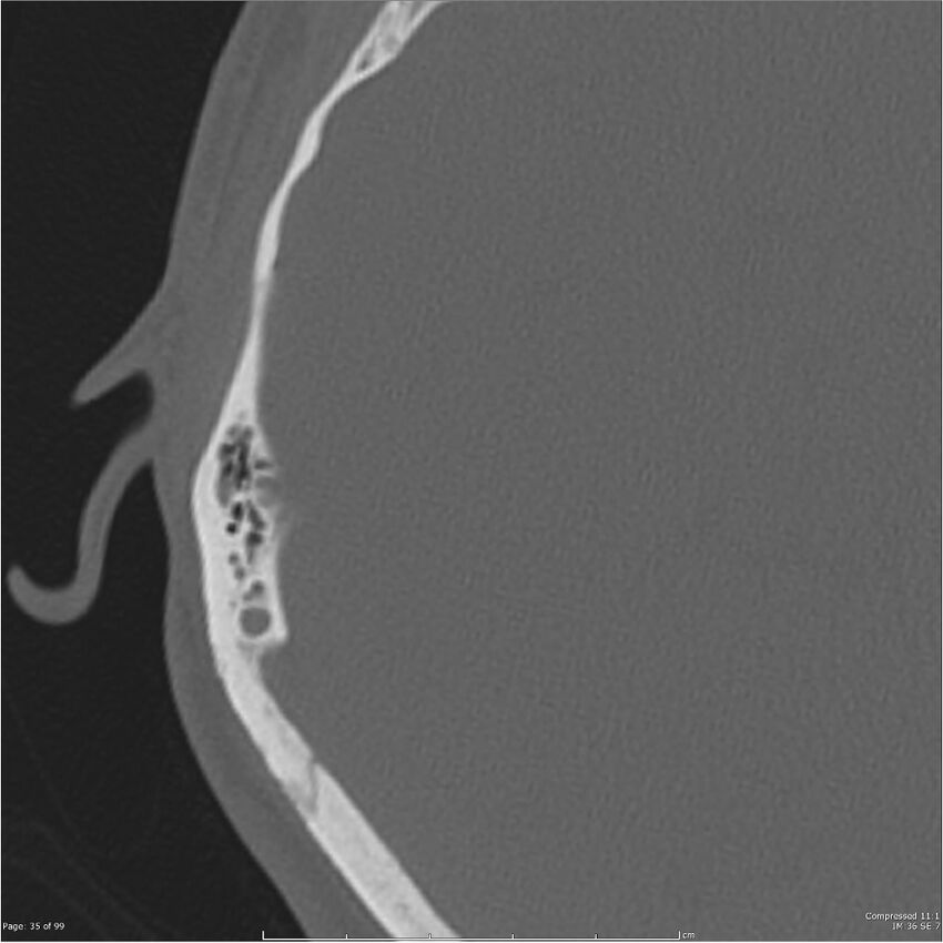 Acute otomastoiditis (Radiopaedia 28276-28512 Axial PTB bone window reformat 15).jpg