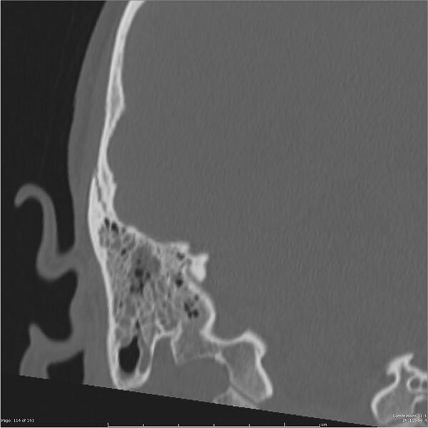 File:Acute otomastoiditis (Radiopaedia 28276-28512 Coronal PTB bone window reformat 45).jpg