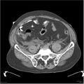 Acute pancreatitis (Radiopaedia 19135-19116 Axial non-contrast 45).jpg